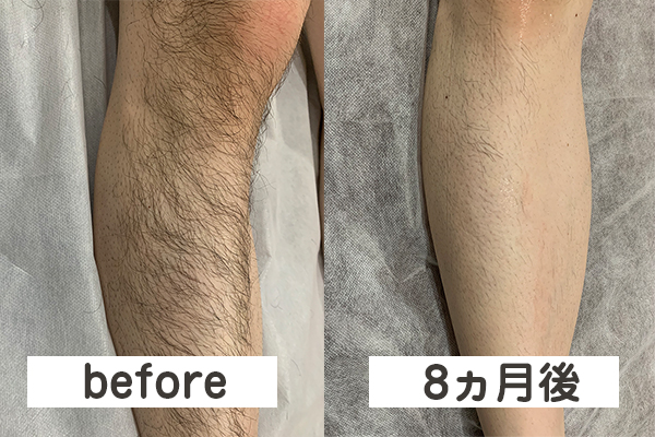 すね毛の脱毛ビフォーアフター